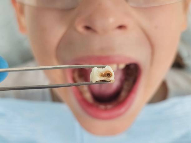 Best Emergency Tooth Extraction in Englewood, TN